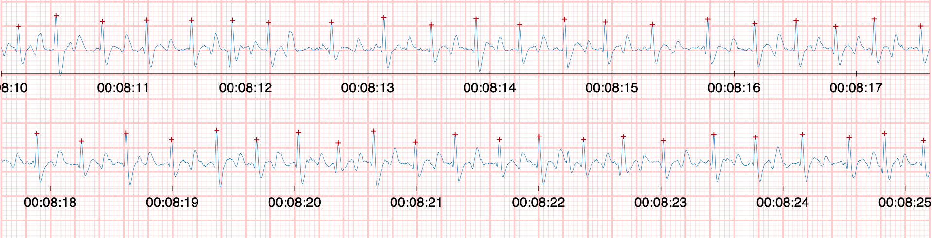Exemple de fibrillation atriale fibrillation atrialle