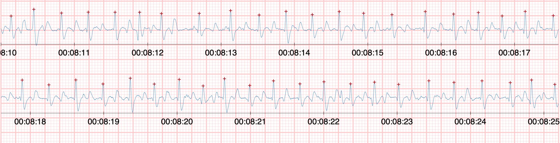Exemple de fibrillation atriale fractures de fatigue chez le cheval
