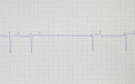 ECG-fibrillation-