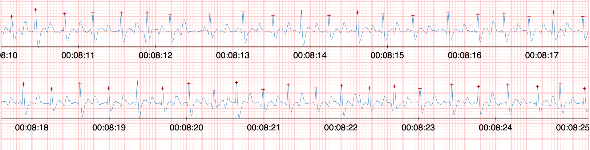 Exemple-de-fibrillation-atriale (1)